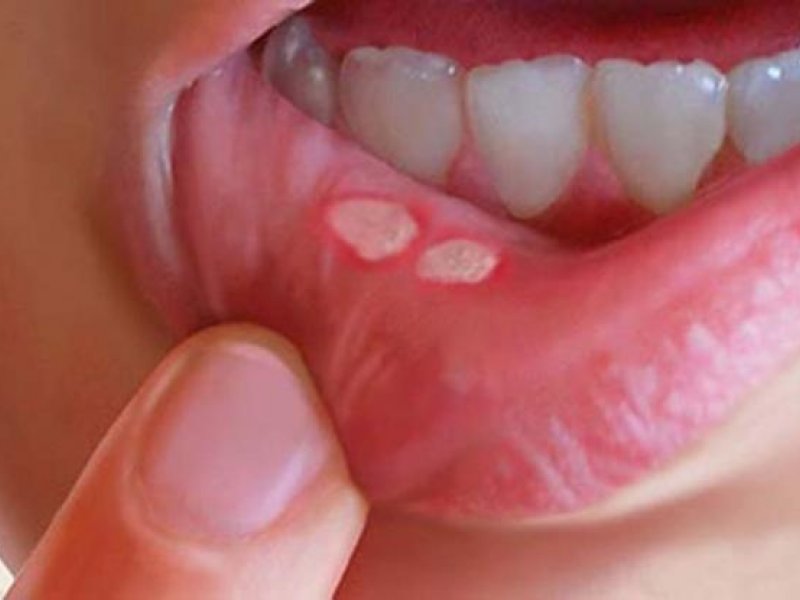 Καρκίνος του στόματος: Τα 13 «ύπουλα» σημάδια