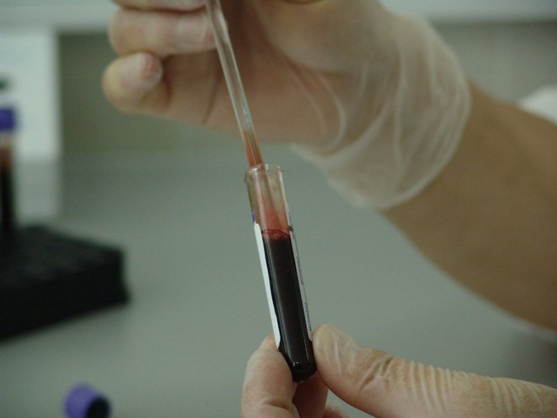 Η ομάδα αίματος έχει καθοριστική σημασία για τον κίνδυνο προσβολης από κορονοϊό