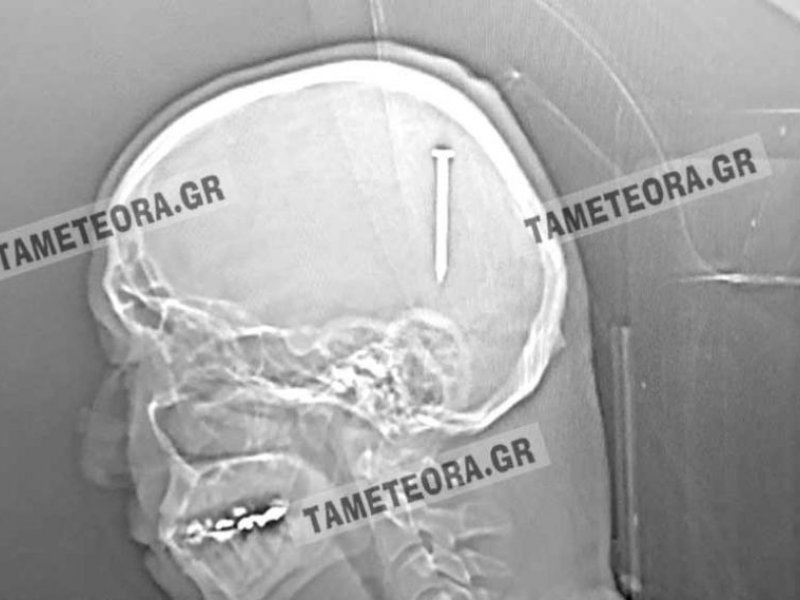 Καλαμπάκα: Kαρφί 5 εκατοστών σφηνώθηκε στο κεφάλι του και δεν ένιωσε τίποτα!