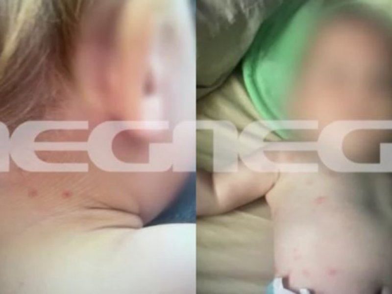 Καβάλα: Φωτογραφίες σοκ - Τα τσιμπήματα από ψύλλους στο κορμάκι του μωρού που σκότωσε ο 56χρονος